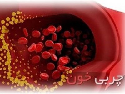 این علائم به شما میگوید چربی خون دارید این علائم به شما میگوید چربی خون دارید