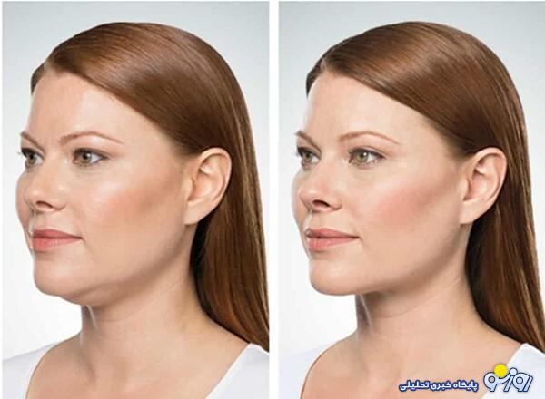 علت لاغری بیش از حد صورت چیست؟ علت لاغری بیش از حد صورت چیست؟